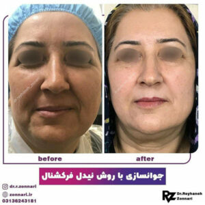 جوانسازی پوست - دکتر زناری