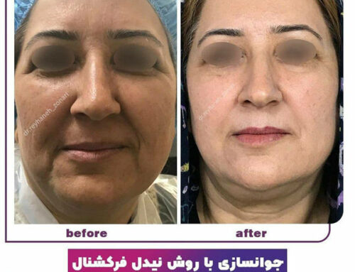 جوانسازی پوست
