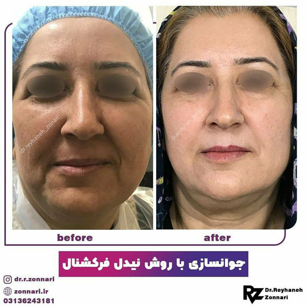 جوانسازی پوست