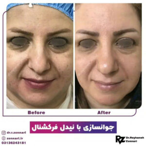 جوانسازی پوست - دکتر زناری