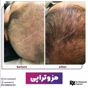 مزوتراپی - دکتر ریحانه زناری