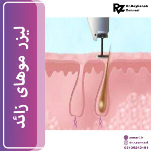 لیزر موهای زائد - دکتر زناری