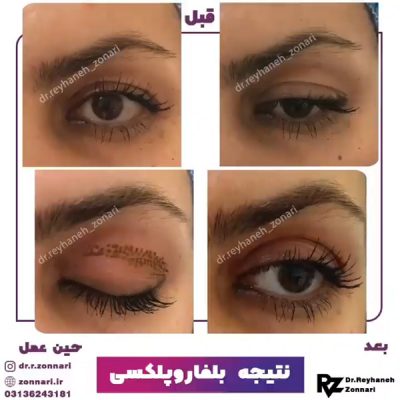بلفاروپلاستی بدون جراحی