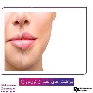 مراقبت های بعد از تزریق ژل