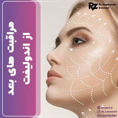 اندولیفت