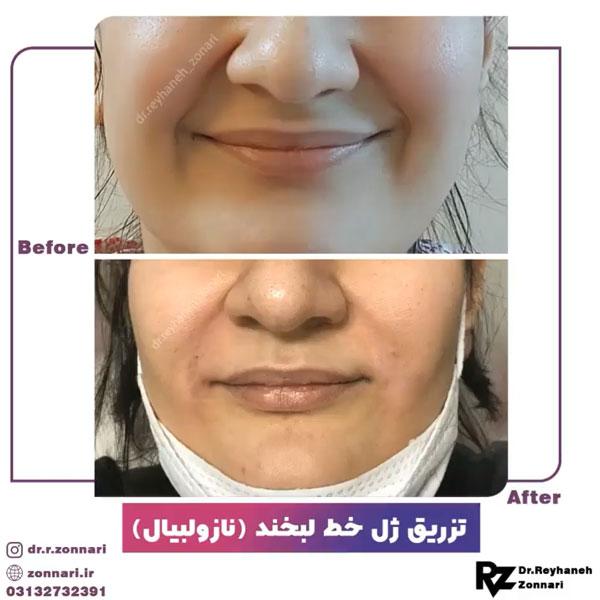 تزریق ژل