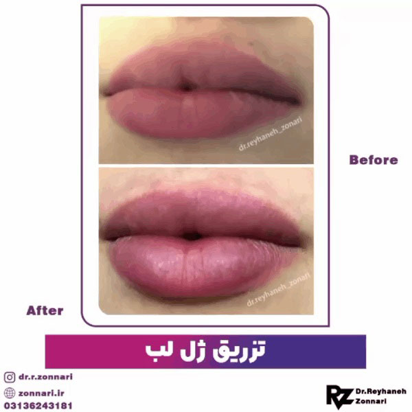 تزریق ژل