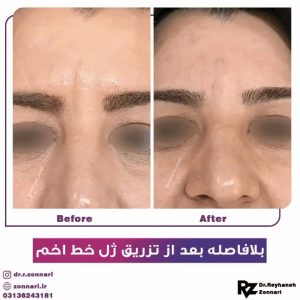 تزریق ژل
