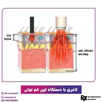 لاغری با دستگاه لیزر کم توان