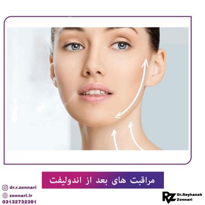 مراقبت های بعد از اندولیفت