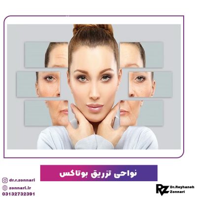 تزریق بوتاکس در اصفهان - دکتر زناری