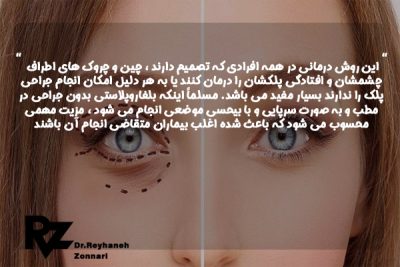 بلفاروپلاستی بدون جراحی در اصفهان - دکتر زناری