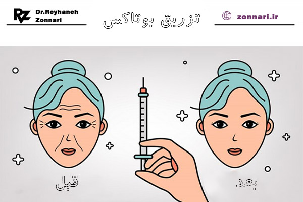 تزریق بوتاکس - دکتر ریحانه زناری در اصفهان
