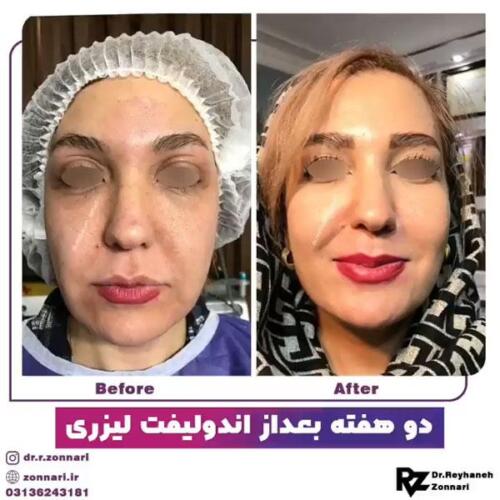 اندولیفت-1