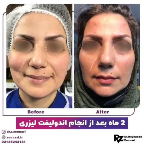اندولیفت-2