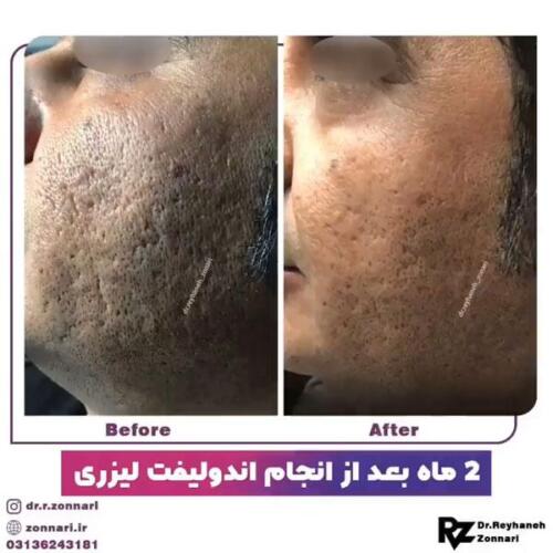 اندولیفت-3