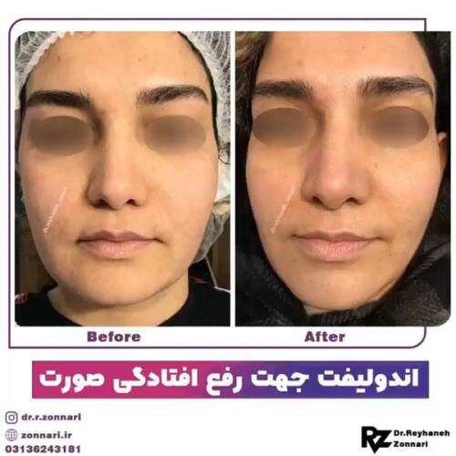اندولیفت-4