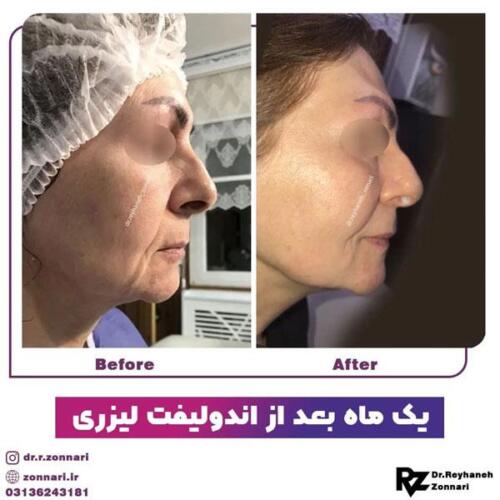 اندولیفت-6