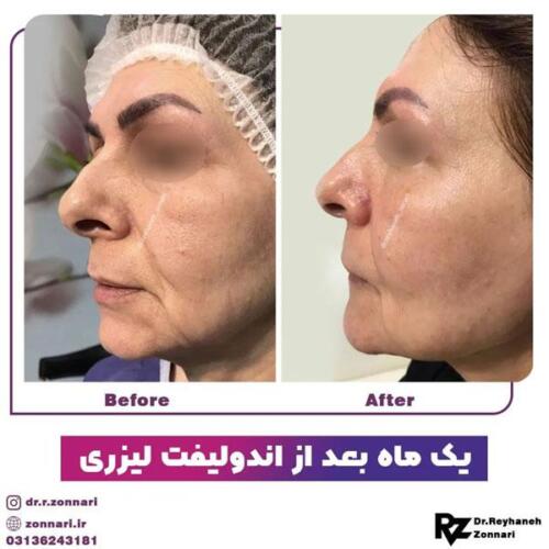 اندولیفت-7