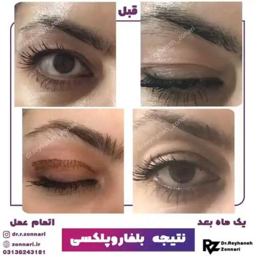 بلفاروپلکسی-1