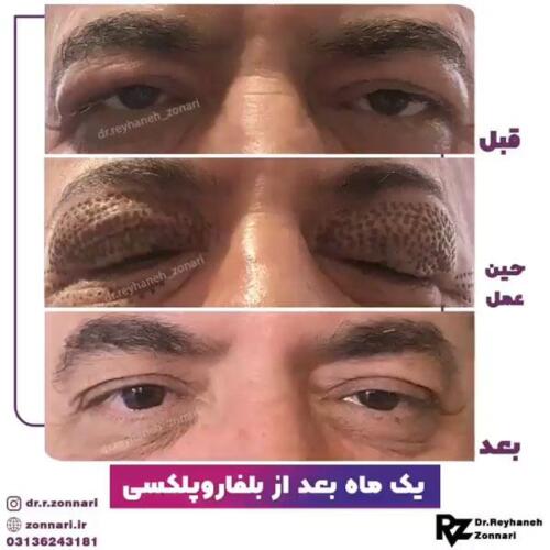 بلفاروپلکسی-3