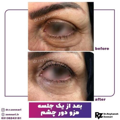 تزریق-مزوژل-1
