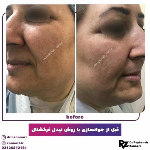 جوانسازی-با-نیدل-فرکشنال-1