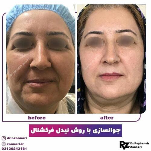 جوانسازی-با-نیدل-فرکشنال-2