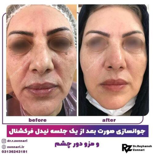 جوانسازی-با-نیدل-فرکشنال-4