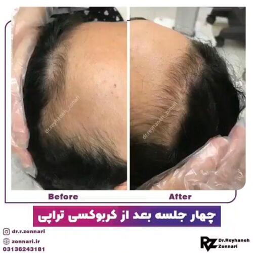 کربوکسی-تراپی-1